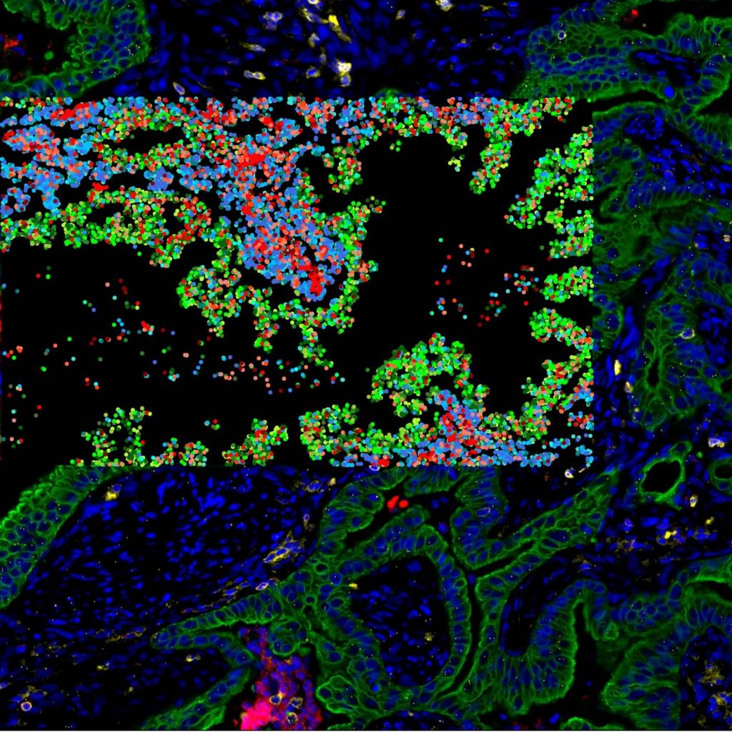 spatial-oncology